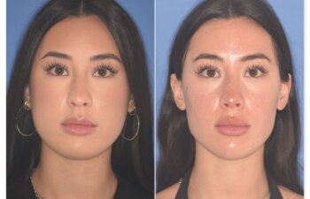Before and after rhinoplasty, 25-year-old patient, front view, 9 months post-op by Dr. Cerrati