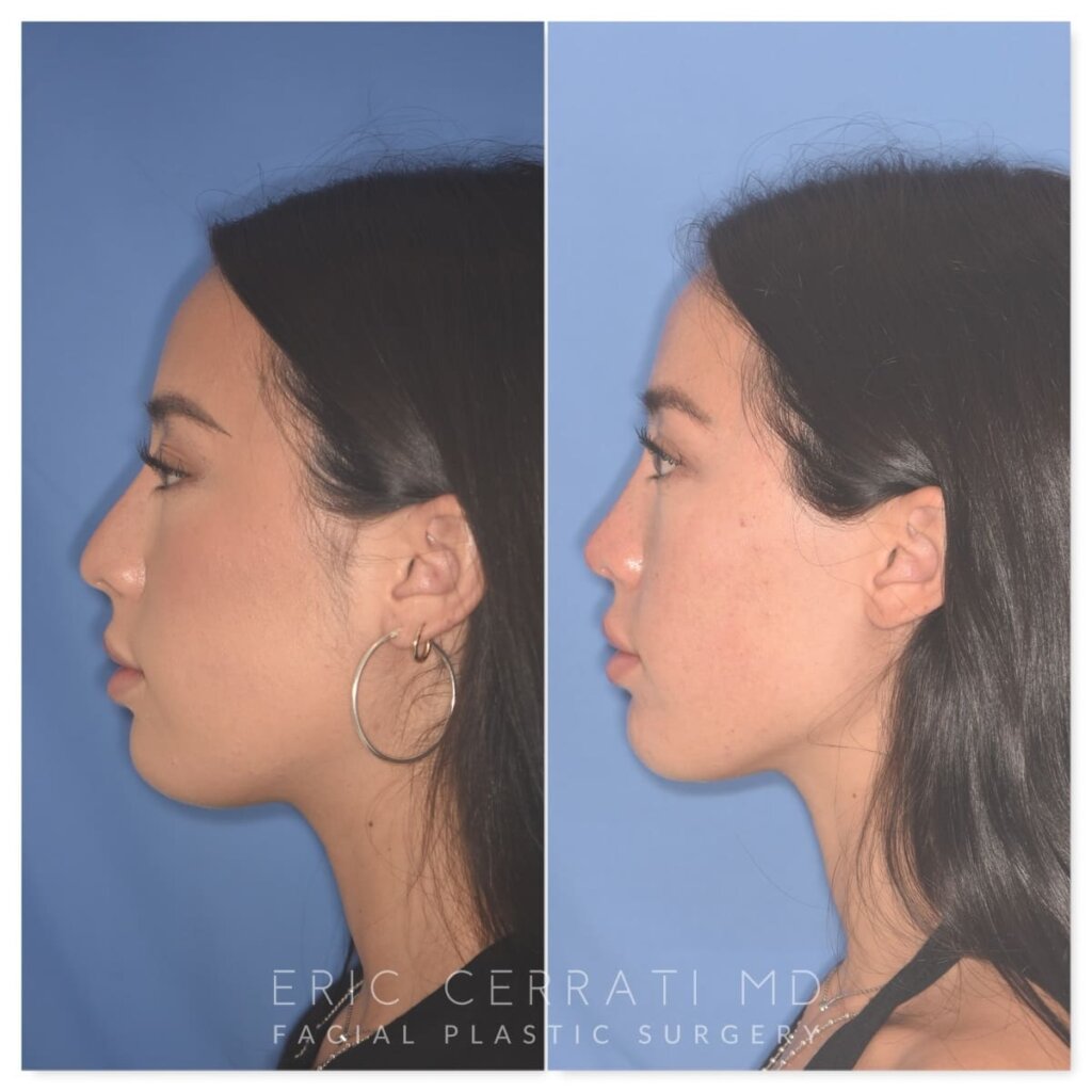 Before and after rhinoplasty, 25-year-old patient, left profile, 9 months post-op by Dr. Cerrati