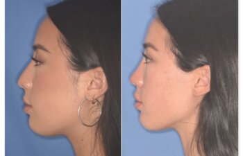 Before and after rhinoplasty, 25-year-old patient, left profile, 9 months post-op by Dr. Cerrati