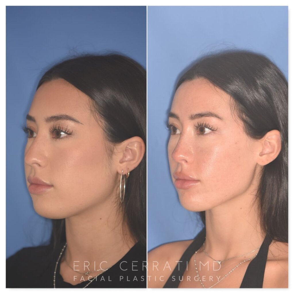 Before and after rhinoplasty, 25-year-old patient, left oblique view, 9 months post-op by Dr. Cerrati