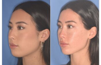 Before and after rhinoplasty, 25-year-old patient, left oblique view, 9 months post-op by Dr. Cerrati