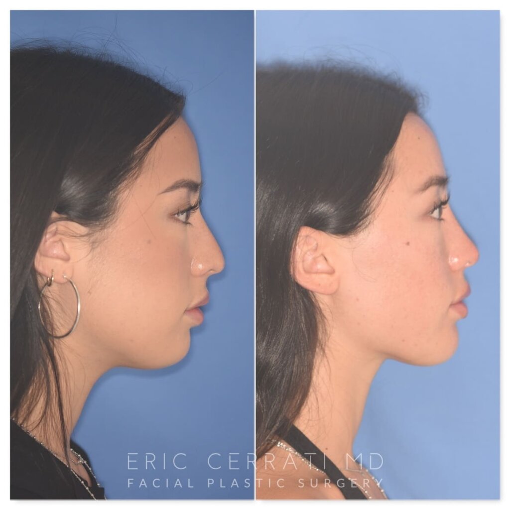 Before and after rhinoplasty, 25-year-old patient, right profile, 9 months post-op by Dr. Cerrati