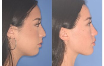Before and after rhinoplasty, 25-year-old patient, right profile, 9 months post-op by Dr. Cerrati
