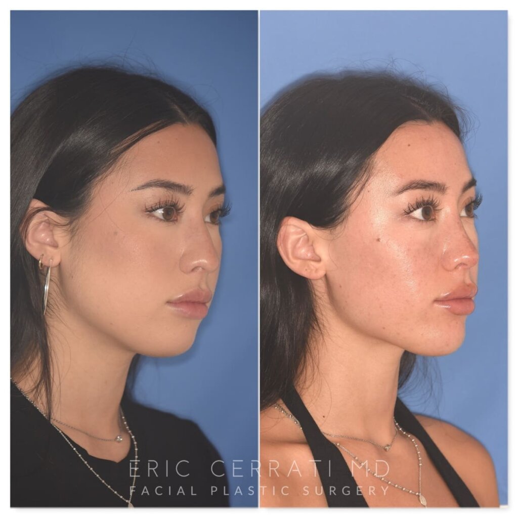 Before and after rhinoplasty, 25-year-old patient, right oblique view, 9 months post-op by Dr. Cerrati