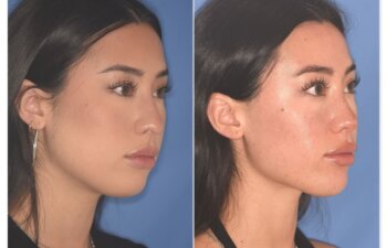 Before and after rhinoplasty, 25-year-old patient, right oblique view, 9 months post-op by Dr. Cerrati