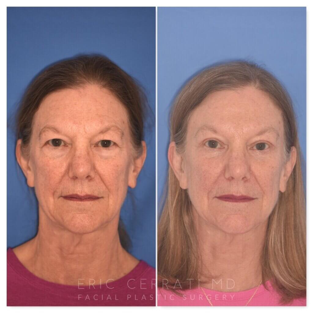 71 YR - 5 Weeks Postop: Endoscopic Browlift + Upper Blepharoplasty + Lower Blepharoplasty