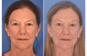 71 YR - 5 Weeks Postop: Endoscopic Browlift + Upper Blepharoplasty + Lower Blepharoplasty