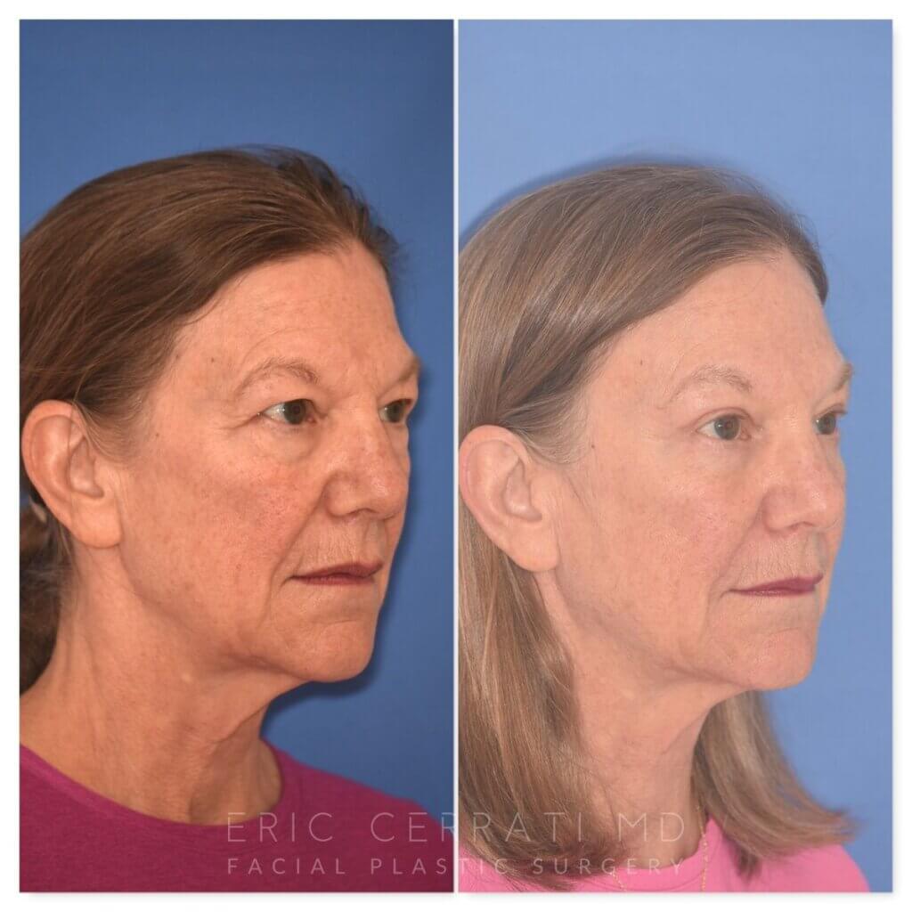 71 YR - 5 Weeks Postop: Endoscopic Browlift + Upper Blepharoplasty + Lower Blepharoplasty