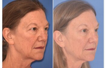 71 YR - 5 Weeks Postop: Endoscopic Browlift + Upper Blepharoplasty + Lower Blepharoplasty