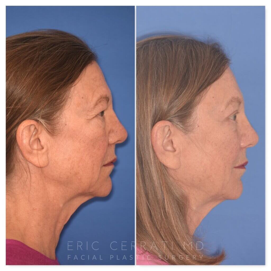 71 YR - 5 Weeks Postop: Endoscopic Browlift + Upper Blepharoplasty + Lower Blepharoplasty