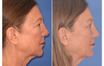 71 YR - 5 Weeks Postop: Endoscopic Browlift + Upper Blepharoplasty + Lower Blepharoplasty
