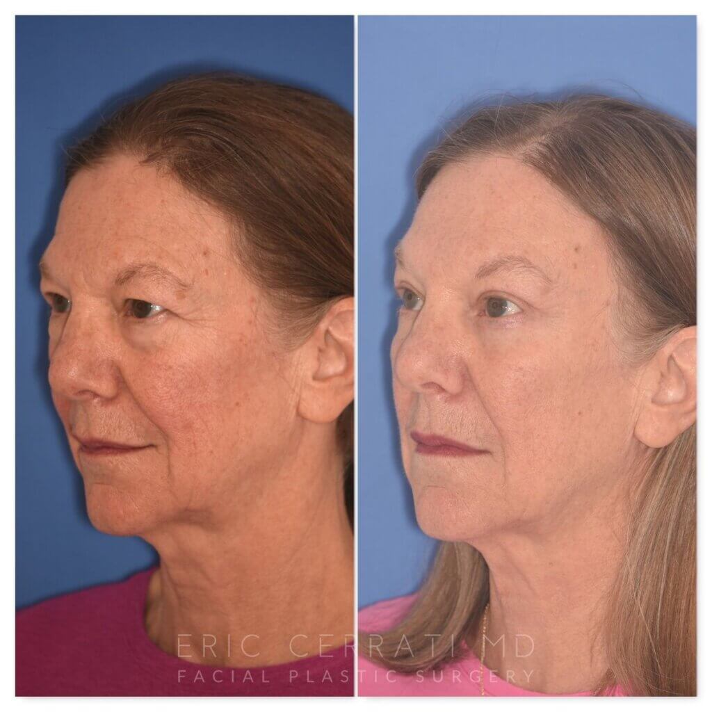 71 YR - 5 Weeks Postop: Endoscopic Browlift + Upper Blepharoplasty + Lower Blepharoplasty