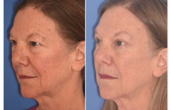 71 YR - 5 Weeks Postop: Endoscopic Browlift + Upper Blepharoplasty + Lower Blepharoplasty
