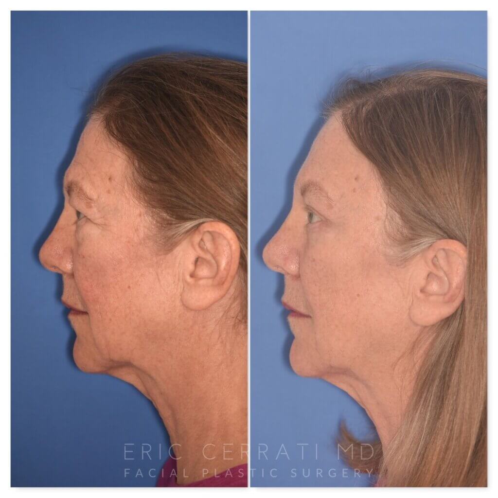71 YR - 5 Weeks Postop: Endoscopic Browlift + Upper Blepharoplasty + Lower Blepharoplasty