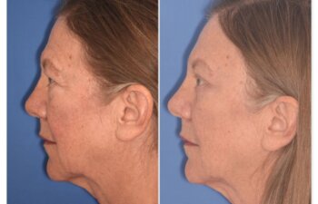 71 YR - 5 Weeks Postop: Endoscopic Browlift + Upper Blepharoplasty + Lower Blepharoplasty