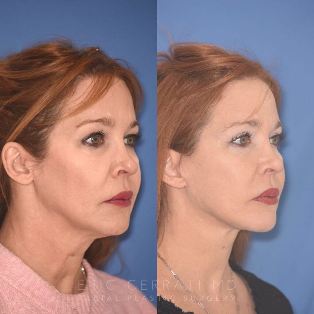 55 YR - 5 Months Postop: Facelift + Upper Blepharoplasty + Lower Blepharoplasty + Laser