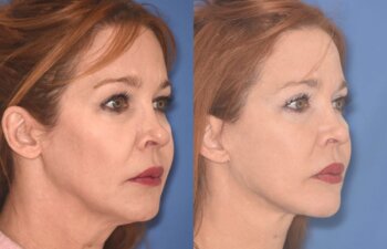 55 YR - 5 Months Postop: Facelift + Upper Blepharoplasty + Lower Blepharoplasty + Laser