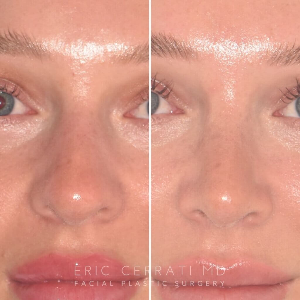 28-year-old patient, 2.5 months after Rhinoplasty by Dr. Cerrati, before and after photo, front view