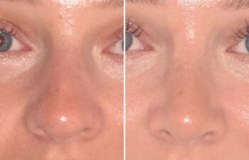 28-year-old patient, 2.5 months after Rhinoplasty by Dr. Cerrati, before and after photo, front view
