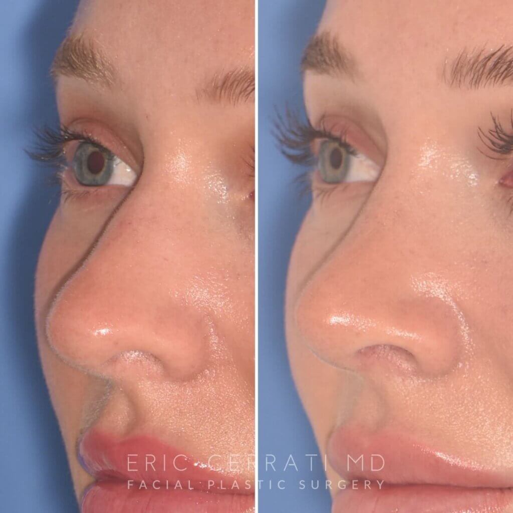 28-year-old patient, 2.5 months after Rhinoplasty by Dr. Cerrati, before and after photo, left oblique view