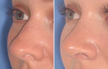 28-year-old patient, 2.5 months after Rhinoplasty by Dr. Cerrati, before and after photo, left oblique view