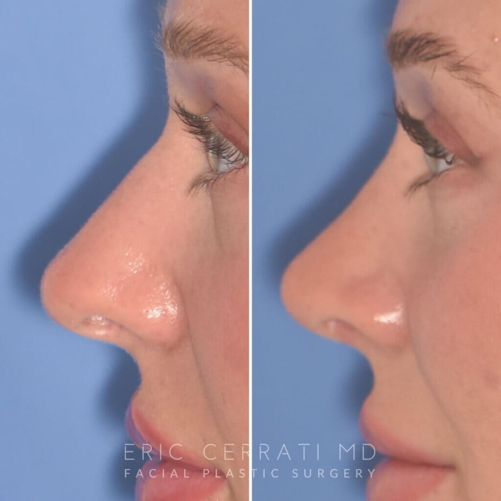 28-year-old patient, 2.5 months after Rhinoplasty by Dr. Cerrati, before and after photo, left side view