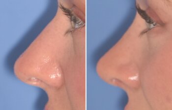 28-year-old patient, 2.5 months after Rhinoplasty by Dr. Cerrati, before and after photo, left side view