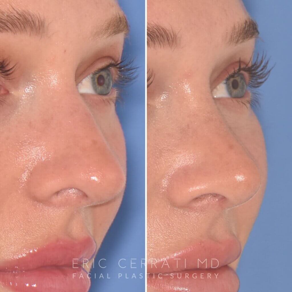 28-year-old patient, 2.5 months after Rhinoplasty by Dr. Cerrati, before and after photo, right oblique side view