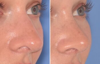 28-year-old patient, 2.5 months after Rhinoplasty by Dr. Cerrati, before and after photo, right oblique side view