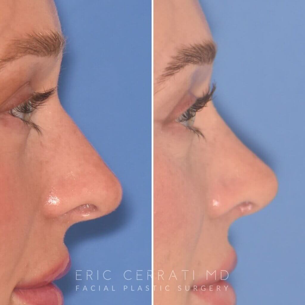 28-year-old patient, 2.5 months after Rhinoplasty by Dr. Cerrati, before and after photo, right side view