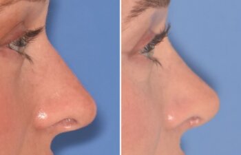 28-year-old patient, 2.5 months after Rhinoplasty by Dr. Cerrati, before and after photo, right side view