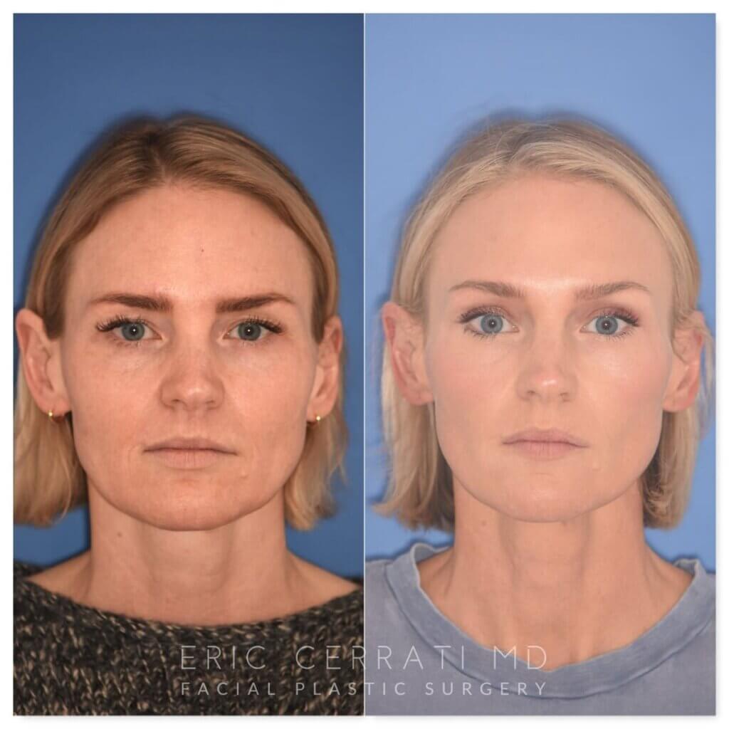 Before and after photo, front, 43-year-old patient, 2 months after endoscopic brow lift and upper blepharoplasty performed by Dr. Cerrati