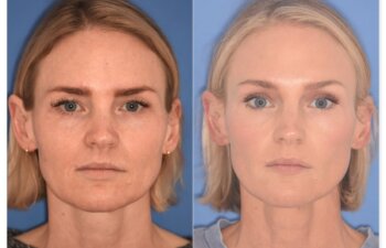 Before and after photo, front, 43-year-old patient, 2 months after endoscopic brow lift and upper blepharoplasty performed by Dr. Cerrati