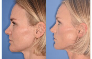 Before and after photo, left side view, 43-year-old patient, 2 months after endoscopic brow lift and upper blepharoplasty performed by Dr. Cerrati