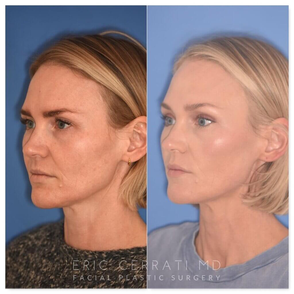 Before and after photo, left oblique view, 43-year-old patient, 2 months after endoscopic brow lift and upper blepharoplasty performed by Dr. Cerrati