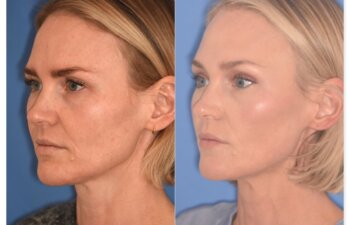 Before and after photo, left oblique view, 43-year-old patient, 2 months after endoscopic brow lift and upper blepharoplasty performed by Dr. Cerrati