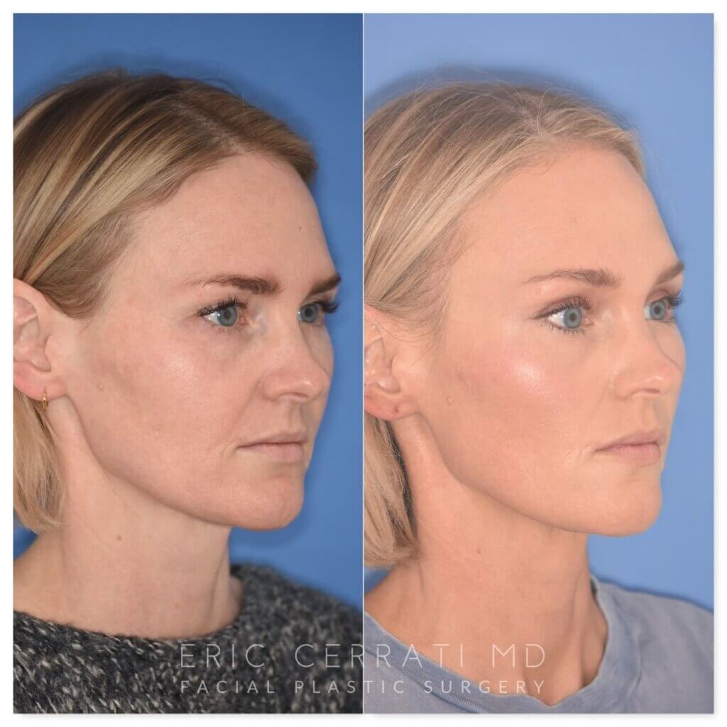 Before and after photo, right oblique view, 43-year-old patient, 2 months after endoscopic brow lift and upper blepharoplasty performed by Dr. Cerrati