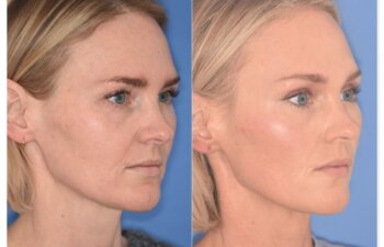 Before and after photo, right oblique view, 43-year-old patient, 2 months after endoscopic brow lift and upper blepharoplasty performed by Dr. Cerrati