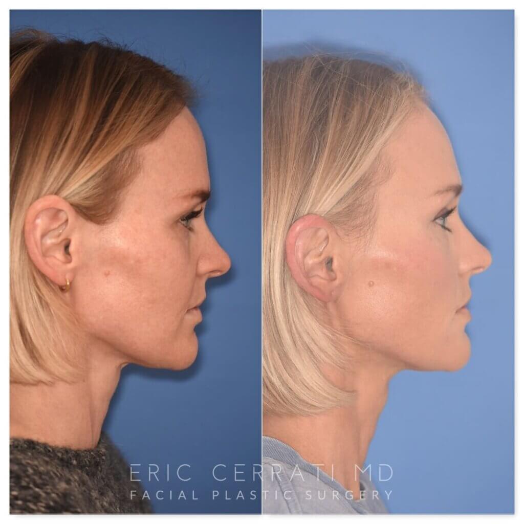 Before and after photo, right side view, 43-year-old patient, 2 months after endoscopic brow lift and upper blepharoplasty performed by Dr. Cerrati