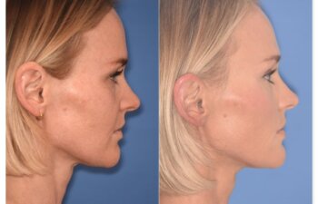 Before and after photo, right side view, 43-year-old patient, 2 months after endoscopic brow lift and upper blepharoplasty performed by Dr. Cerrati