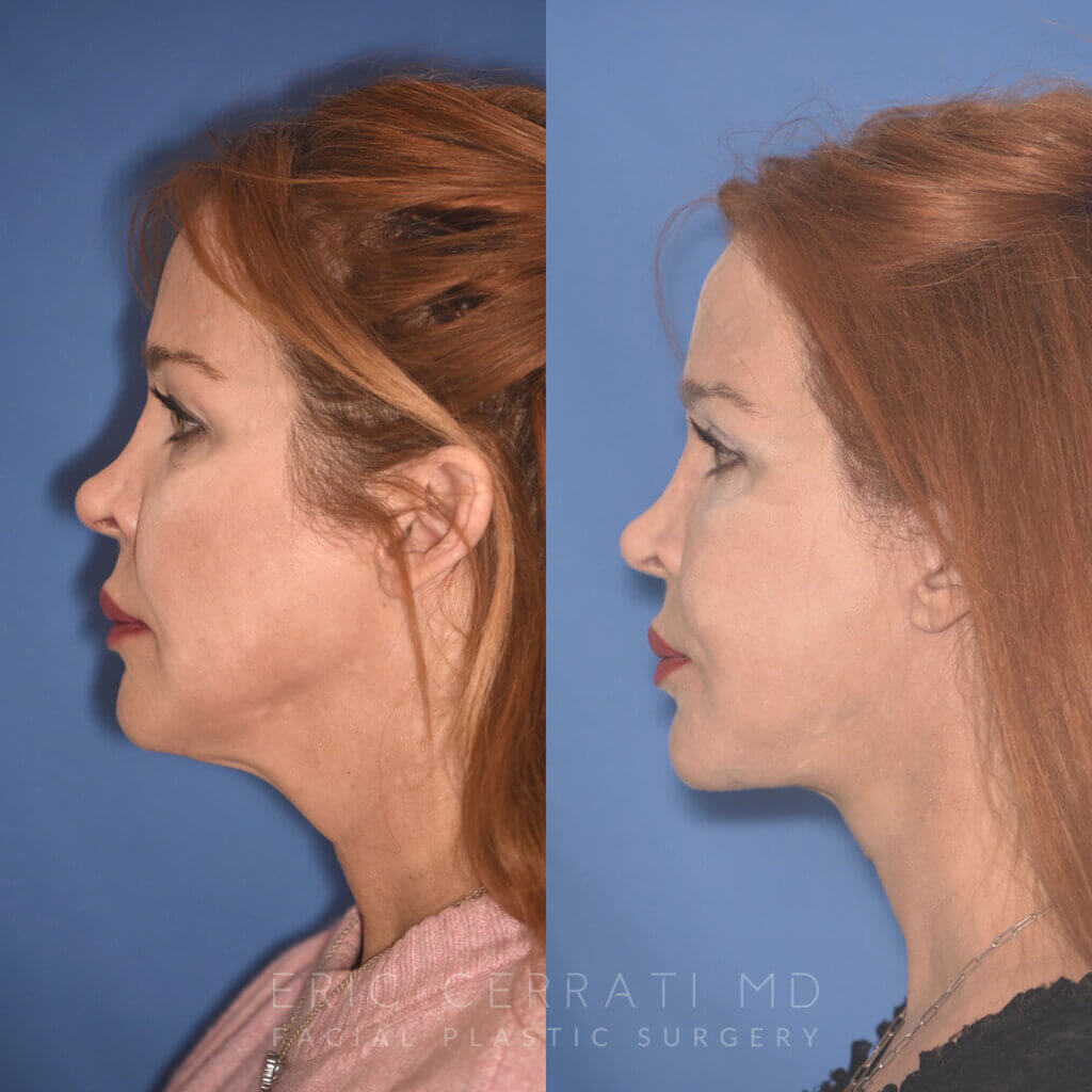 55 YR - 5 Months Postop: Facelift + Upper Blepharoplasty + Lower Blepharoplasty + Laser