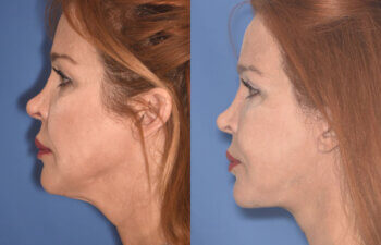 55 YR - 5 Months Postop: Facelift + Upper Blepharoplasty + Lower Blepharoplasty + Laser