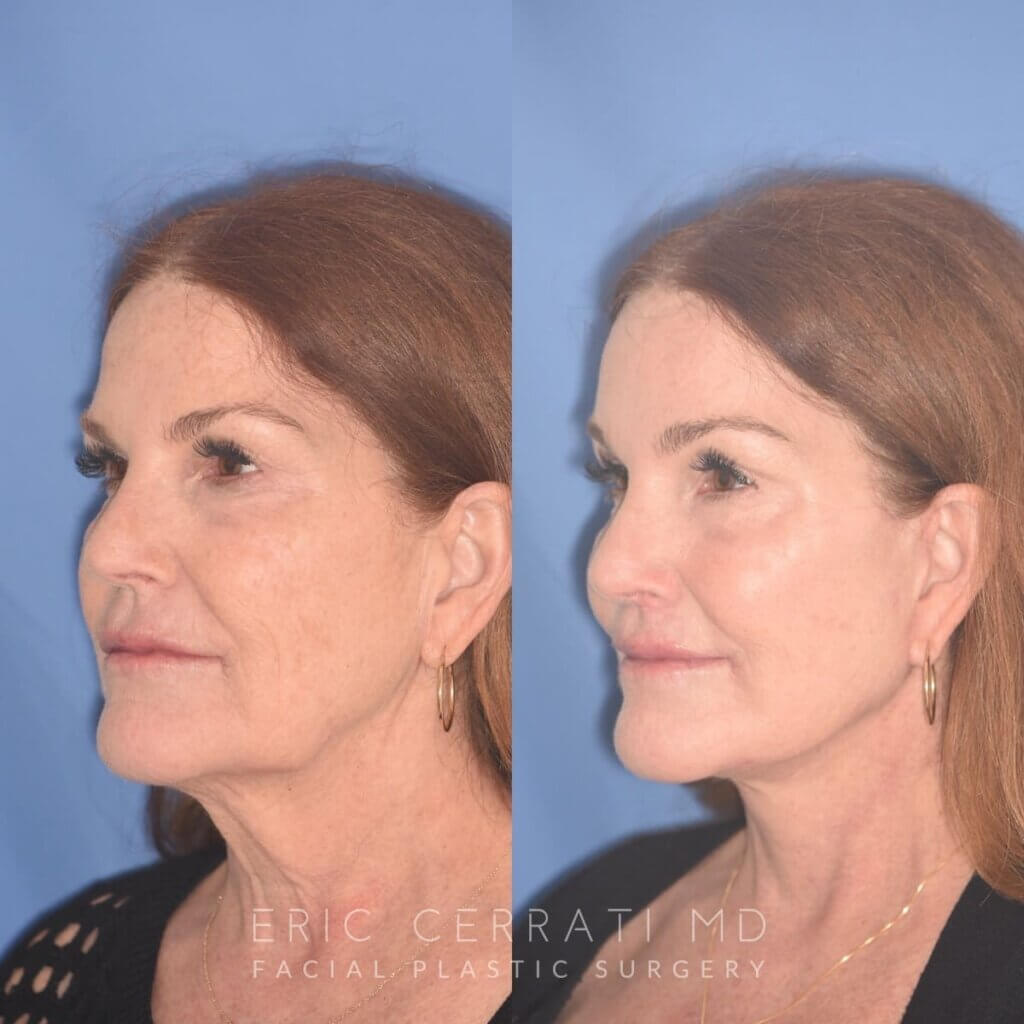 Before and After, 61-year-old patient, 3 months post-op: Endoscopic Browlift, Facelift, Liplift, and Laser, performed by Dr. Cerrati, left oblique view.