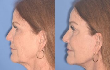 Before and After, 61-year-old patient, 3 months post-op: Endoscopic Browlift, Facelift, Liplift, and Laser, performed by Dr. Cerrati, left view.