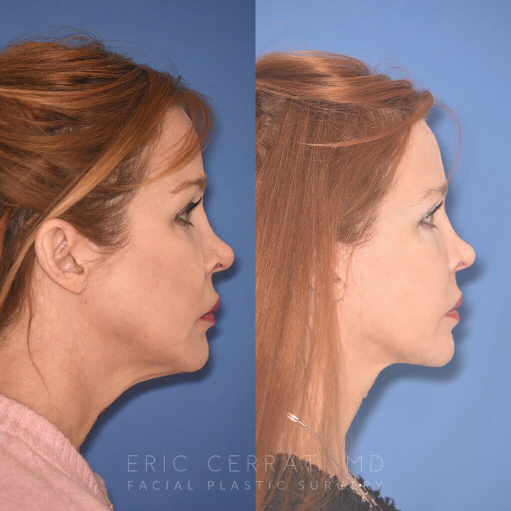 55 YR - 5 Months Postop: Facelift + Upper Blepharoplasty + Lower Blepharoplasty + Laser
