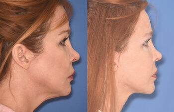 55 YR - 5 Months Postop: Facelift + Upper Blepharoplasty + Lower Blepharoplasty + Laser