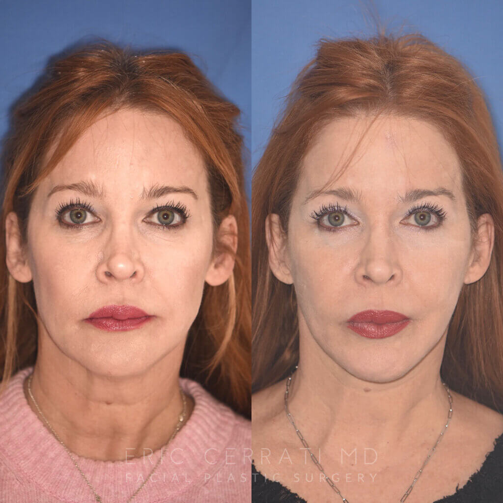 55 YR - 5 Months Postop: Facelift + Upper Blepharoplasty + Lower Blepharoplasty + Laser