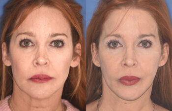 55 YR - 5 Months Postop: Facelift + Upper Blepharoplasty + Lower Blepharoplasty + Laser
