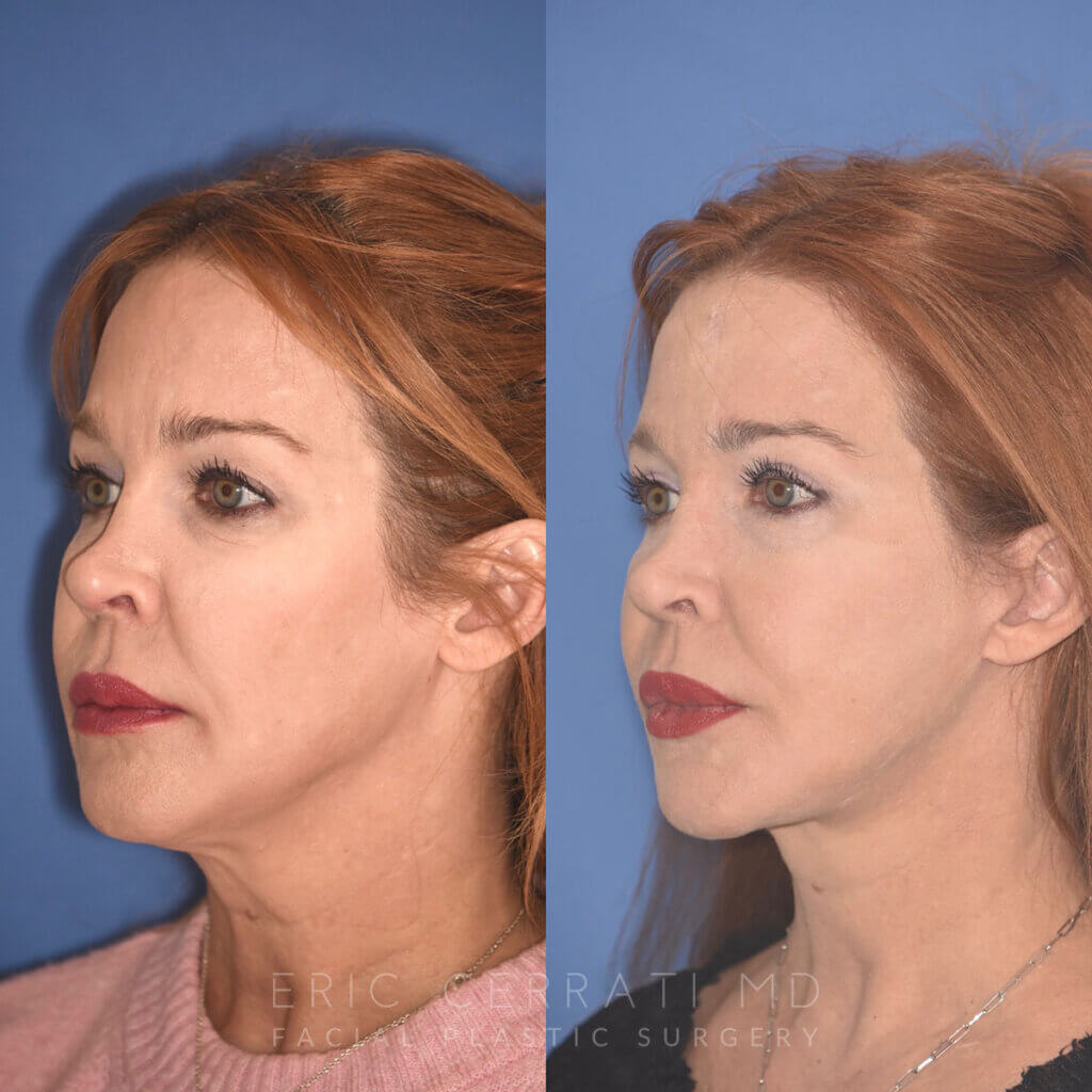 55 YR - 5 Months Postop: Facelift + Upper Blepharoplasty + Lower Blepharoplasty + Laser