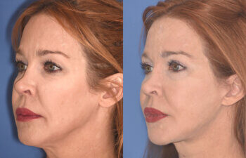 55 YR - 5 Months Postop: Facelift + Upper Blepharoplasty + Lower Blepharoplasty + Laser